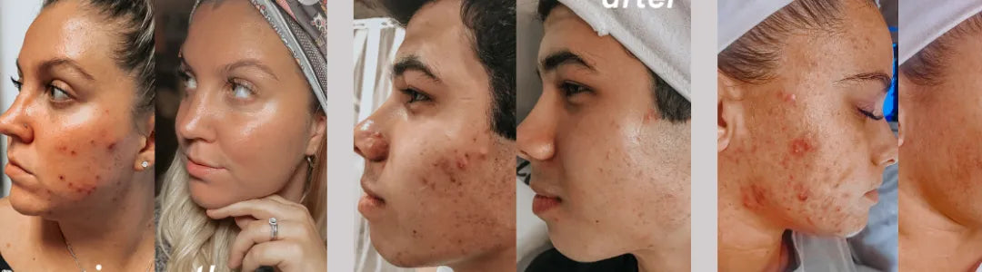 Say Goodbye to Acne with the Right Skincare Regimen
