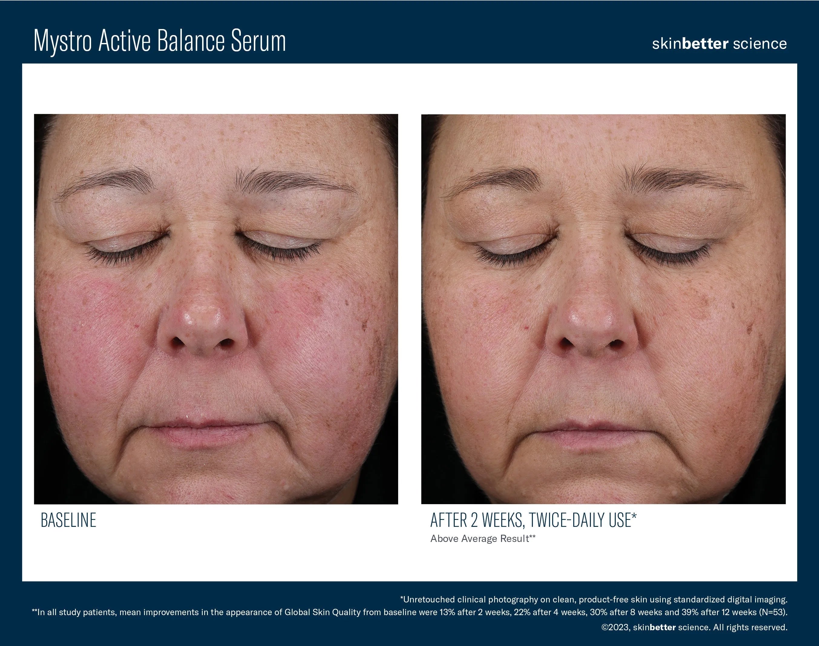 Before-and-after results of Mystro Active Balance Serum, showing reduced redness and improved skin texture after 2 weeks of twice-daily use.