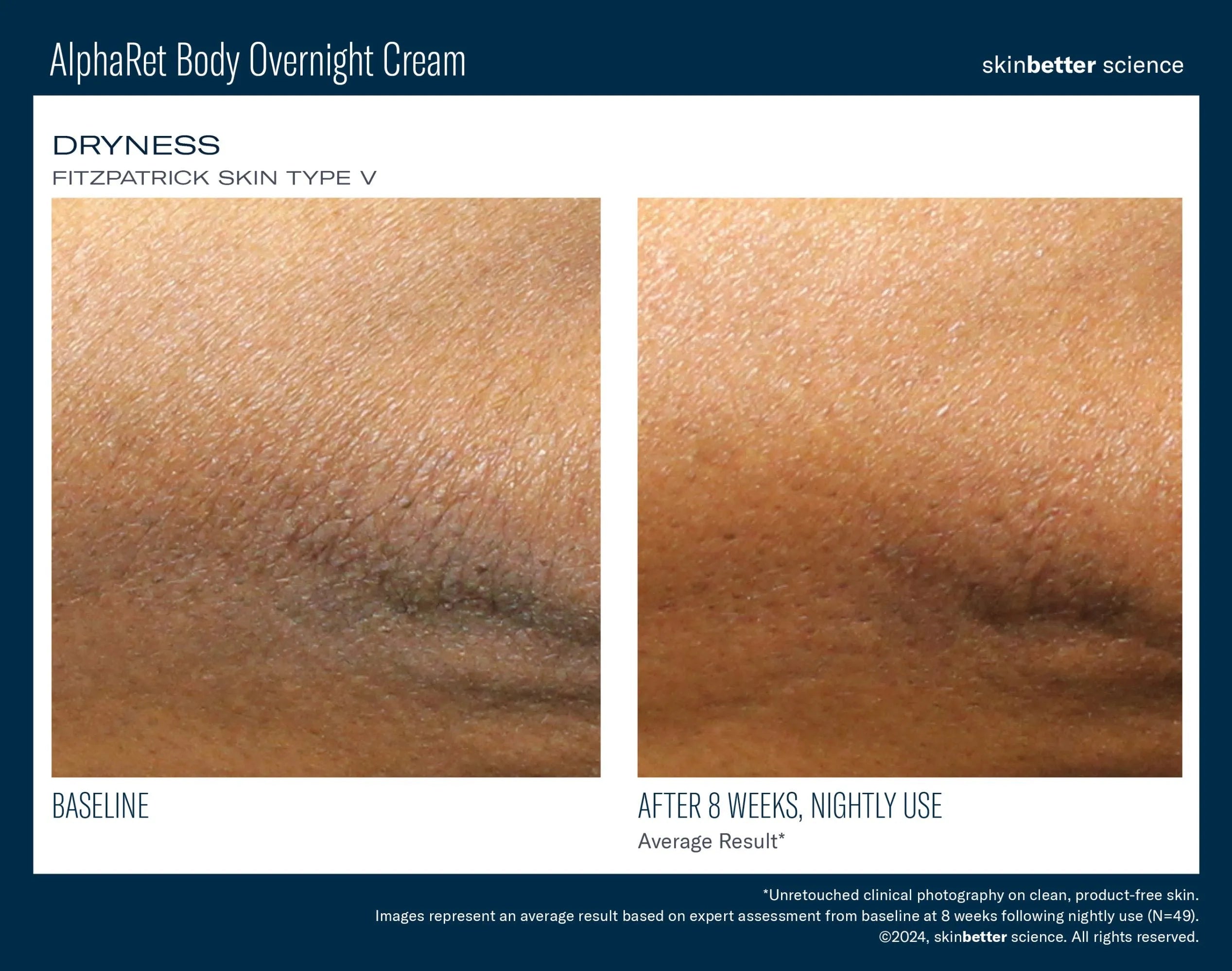 Before and after of skin dryness on Fitzpatrick type V, 8 weeks using AlphaRet Body Overnight Cream.