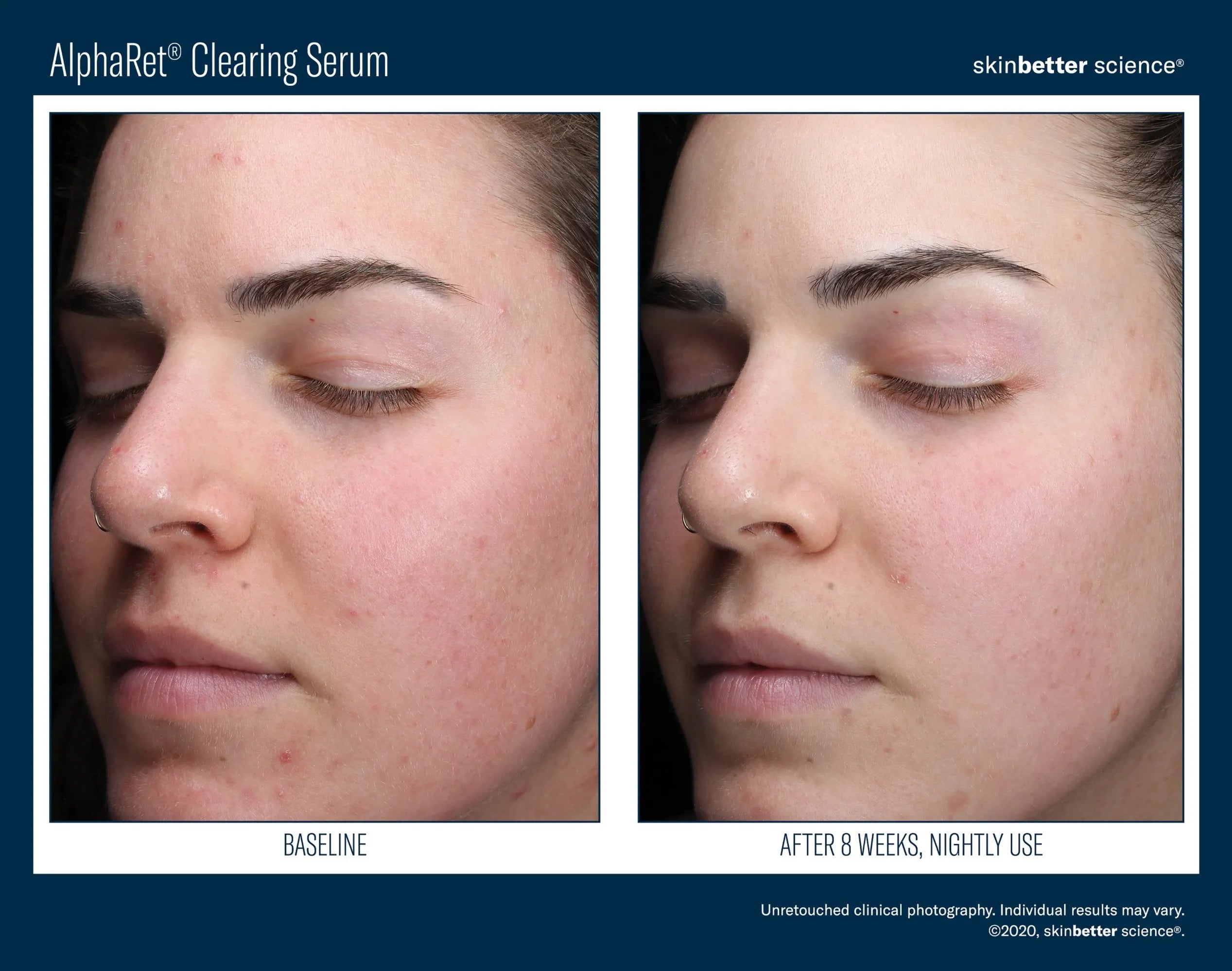 AlphaRet Clearing Serum before and after results showing clearer skin improvement after 8 weeks.