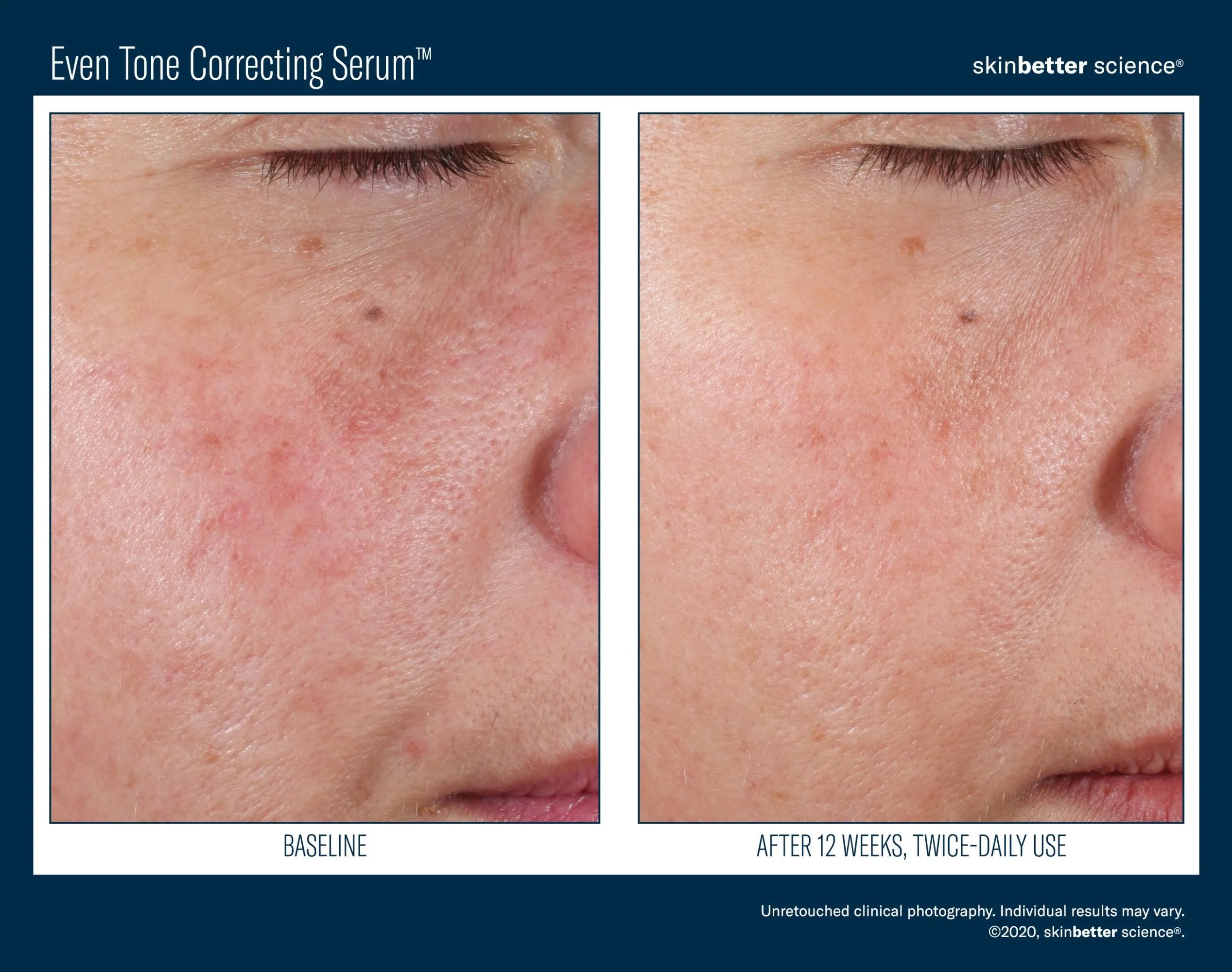 Before and after close-up of facial skin showing improved tone with skincare serum.