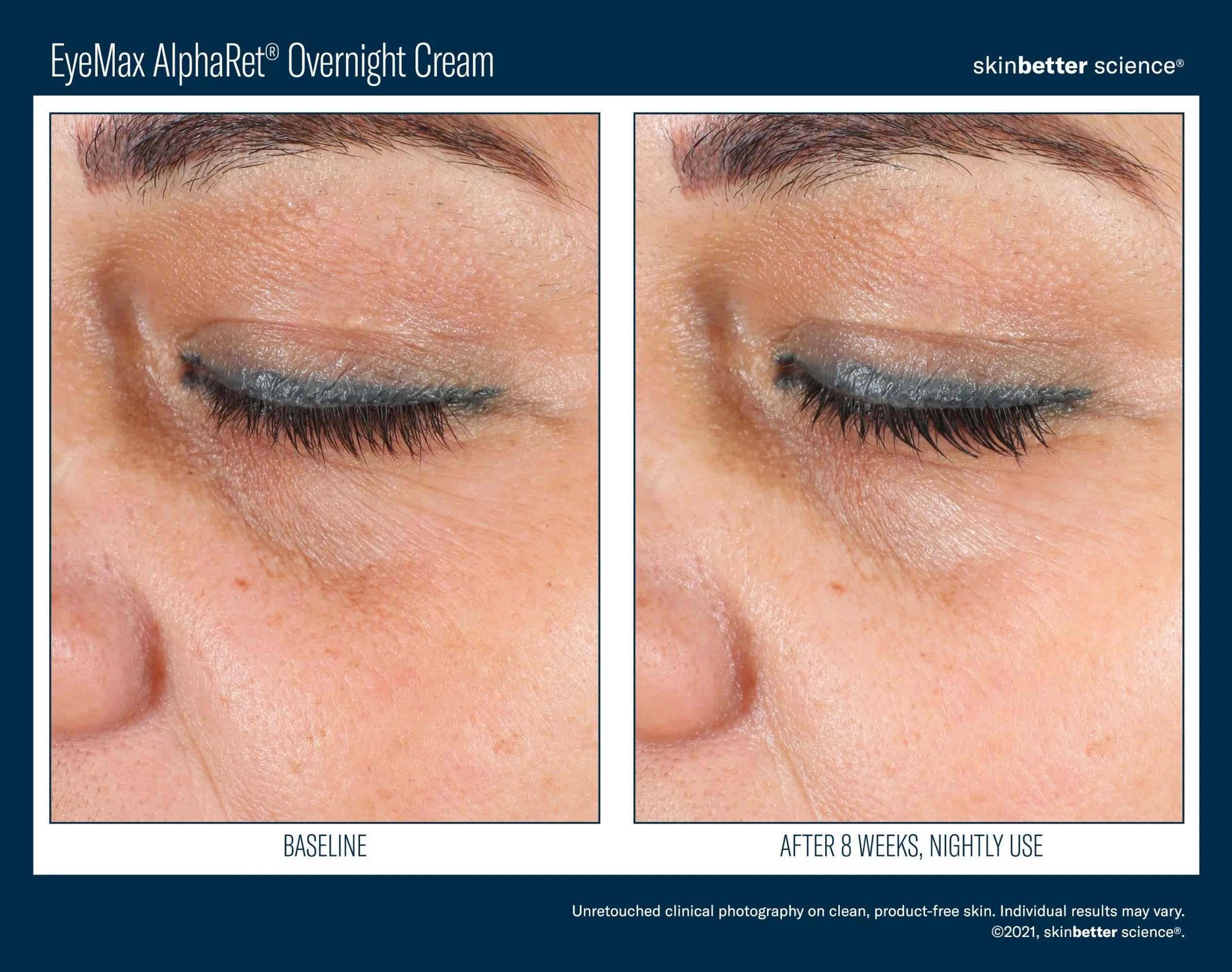 EyeMax AlphaRet Overnight Cream before and after results on under-eye fine lines, Bohemia Skin