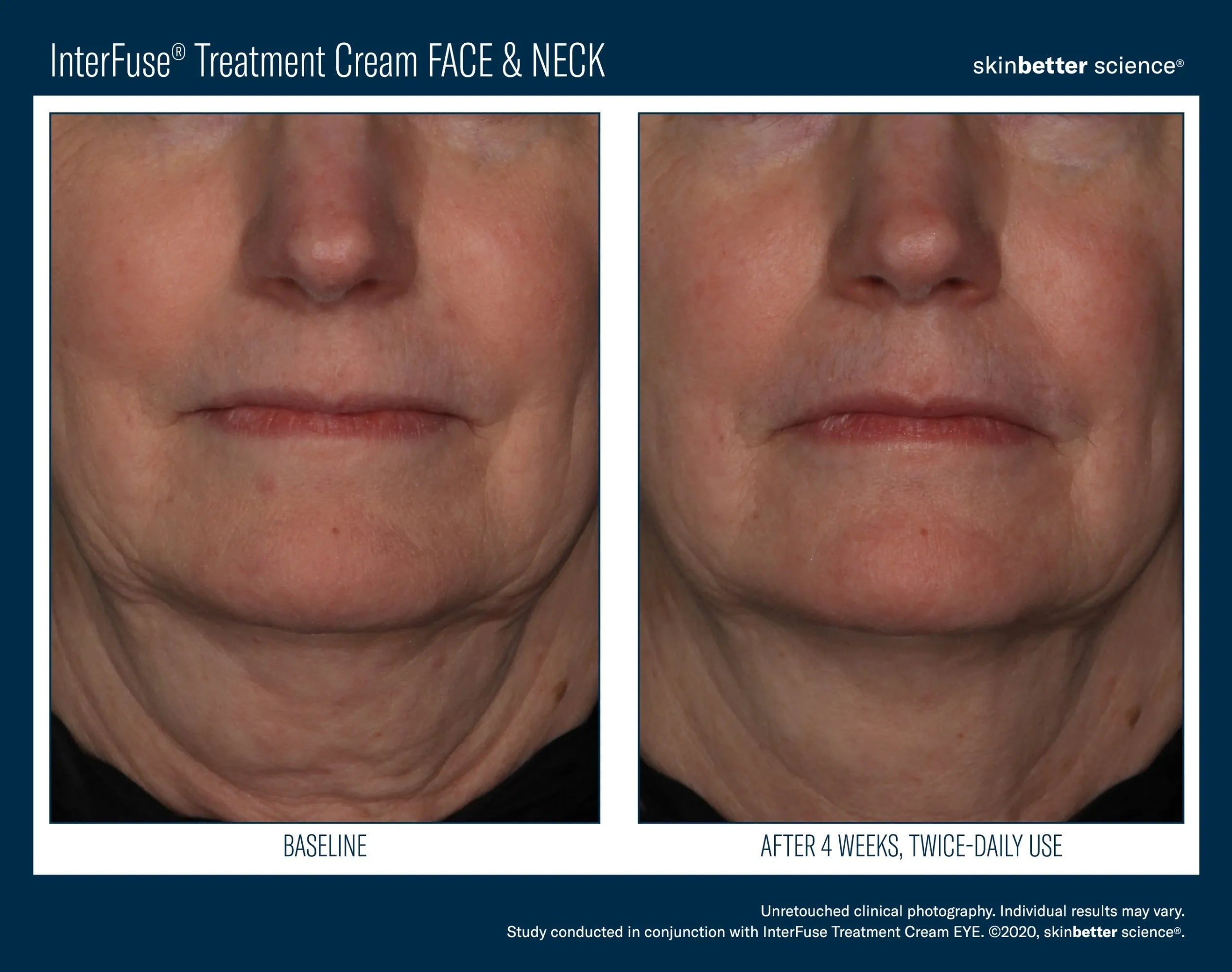 Before and after close-up of a woman's lower face and neck using treatment cream, visible skin improvement.