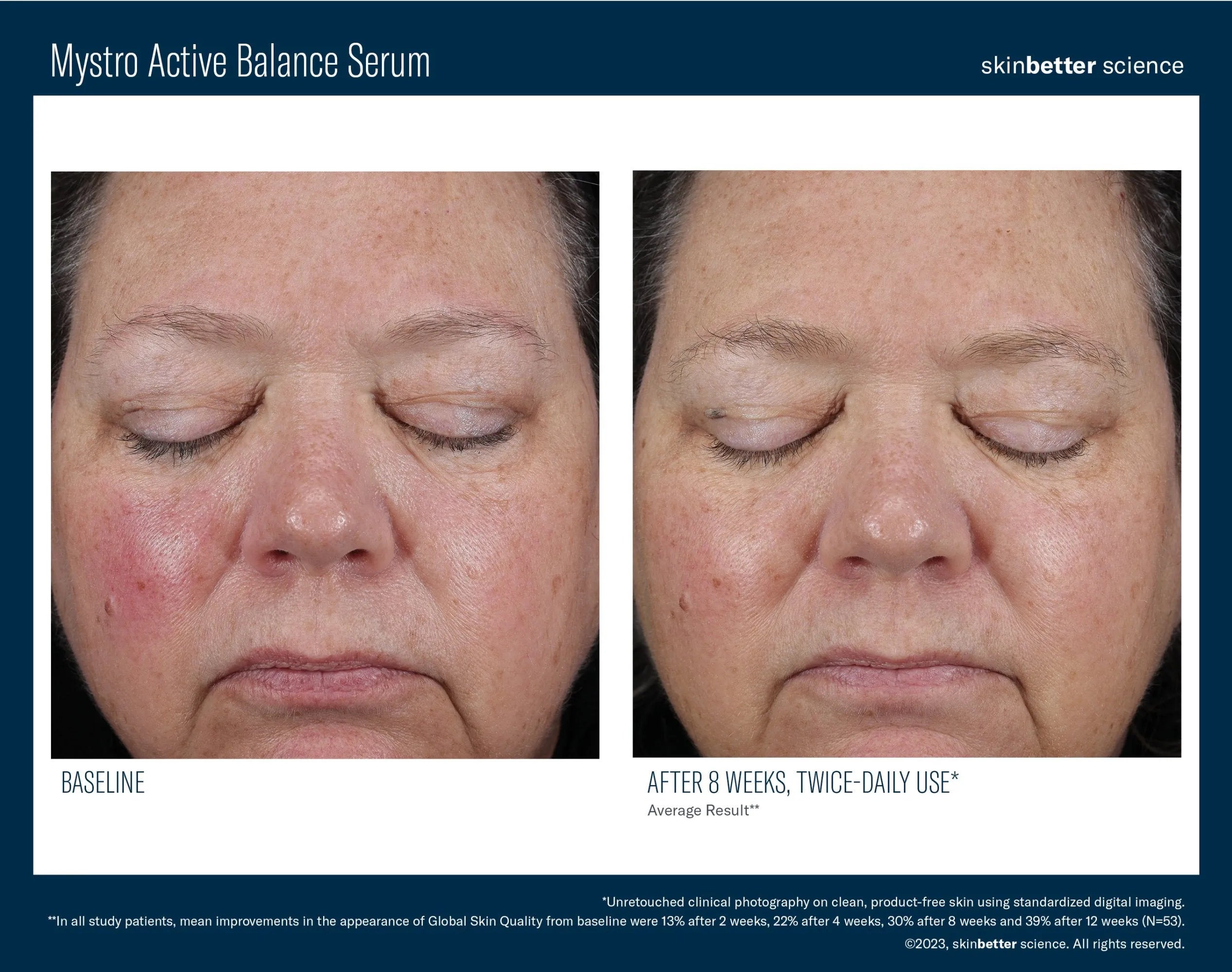 Before and after close-up of woman’s face showing skin improvement from Mystro Active Balance Serum