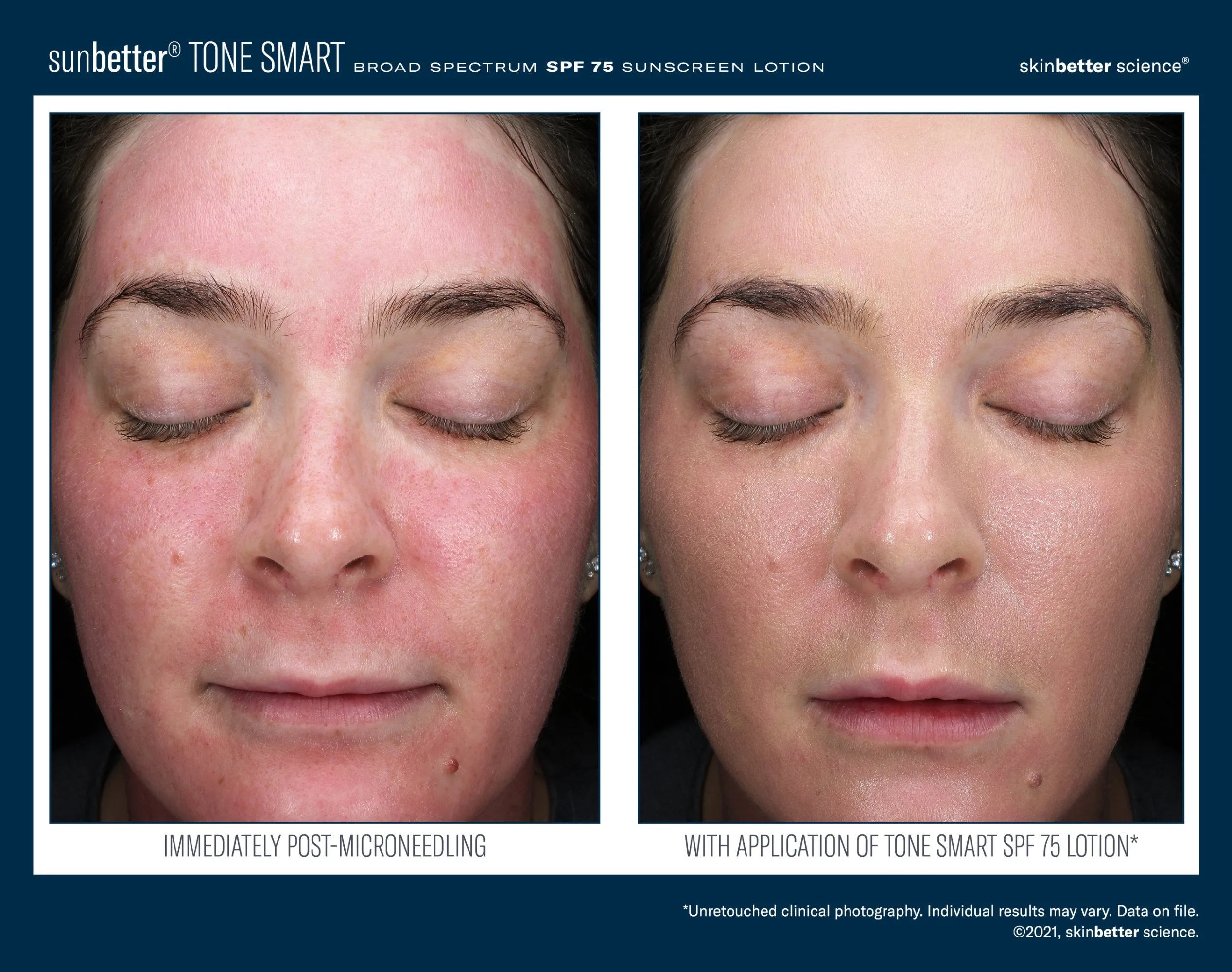 Before and after face close-ups showing redness reduction with Tone Smart SPF 75 sunscreen lotion.