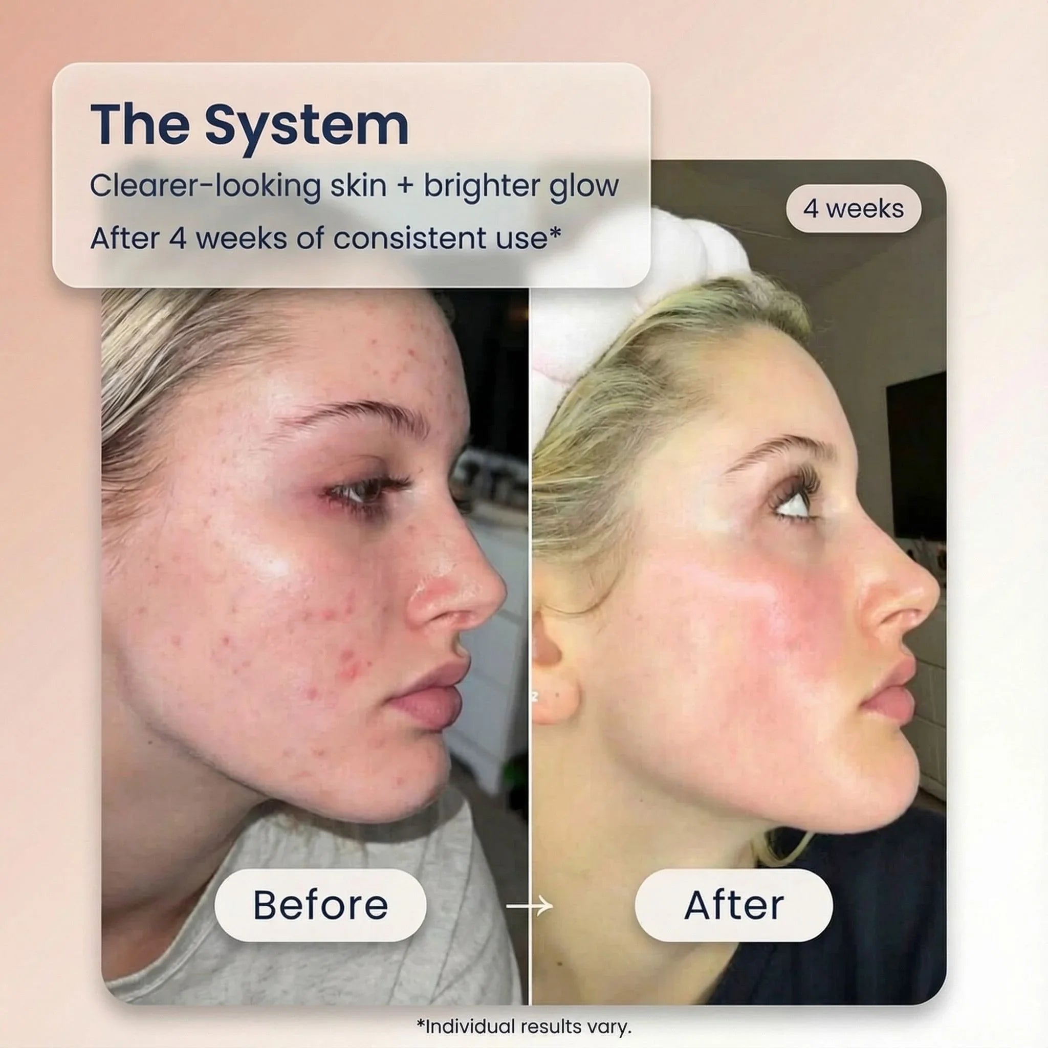 Bohemia Skin before and after results, clearer skin after 4 weeks of holistic skincare use.
