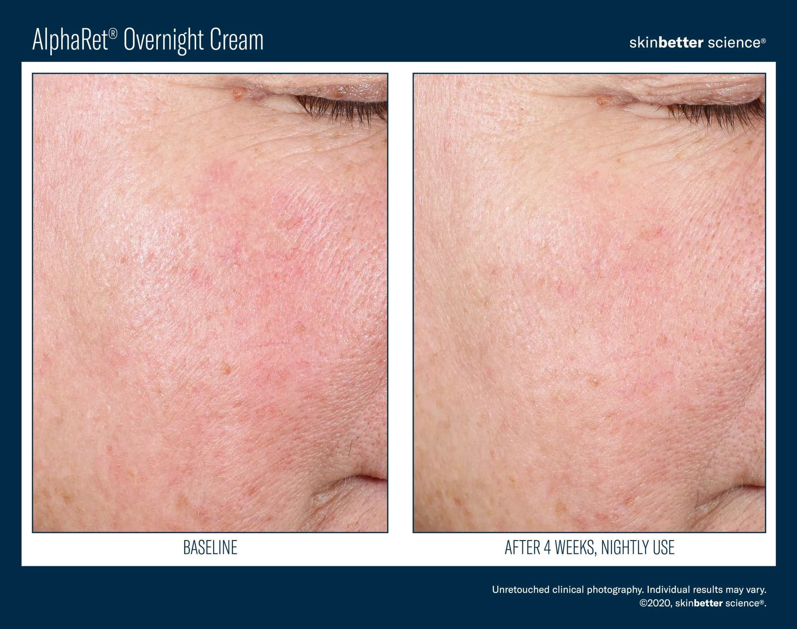 AlphaRet Overnight Cream before and after results on facial skin, 4-week comparison close-up
