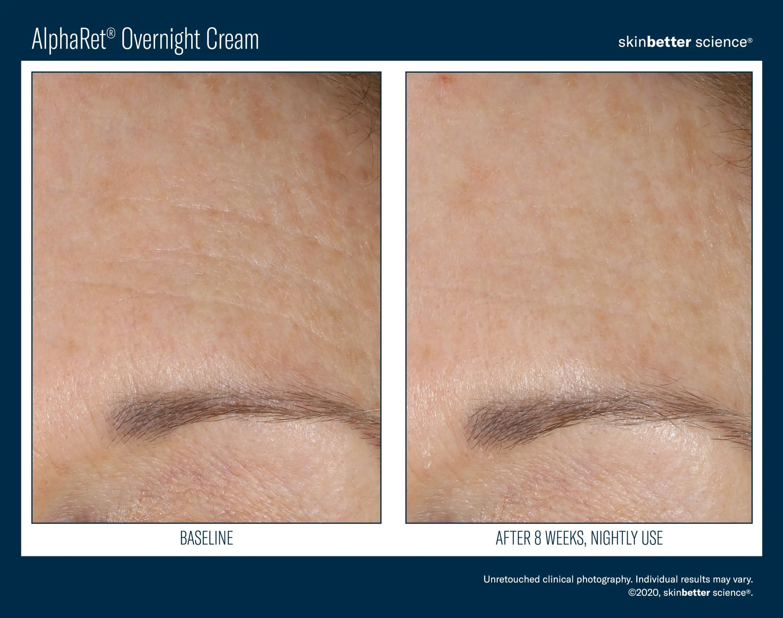 Forehead skin before and after 8 weeks of AlphaRet Overnight Cream, showing smoother texture.