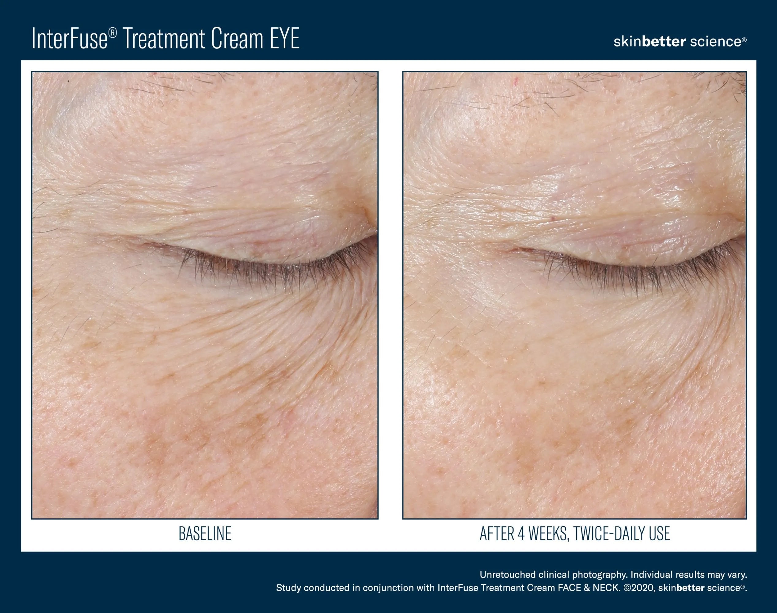 Close-up before and after of eye area showing reduced wrinkles after skincare treatment