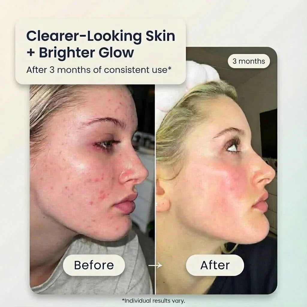 Before and after of a woman showing clearer, glowing skin after using Bohemia Skin for 3 months.