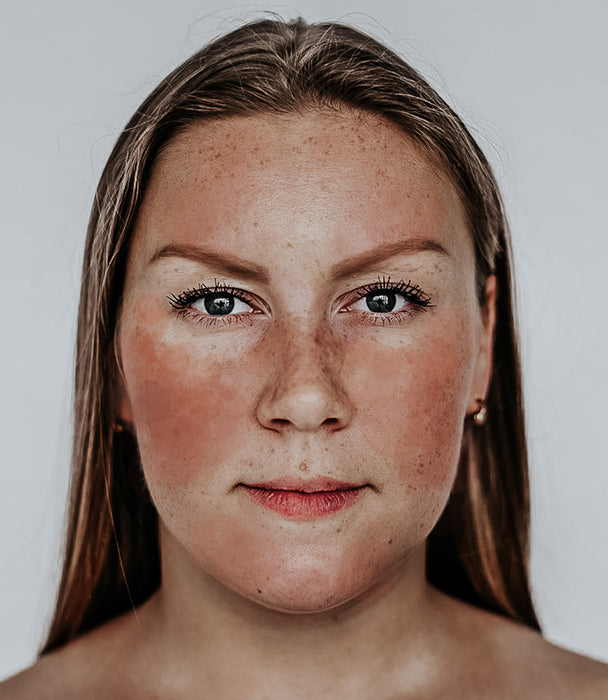 rosacea - Bohemia Skin