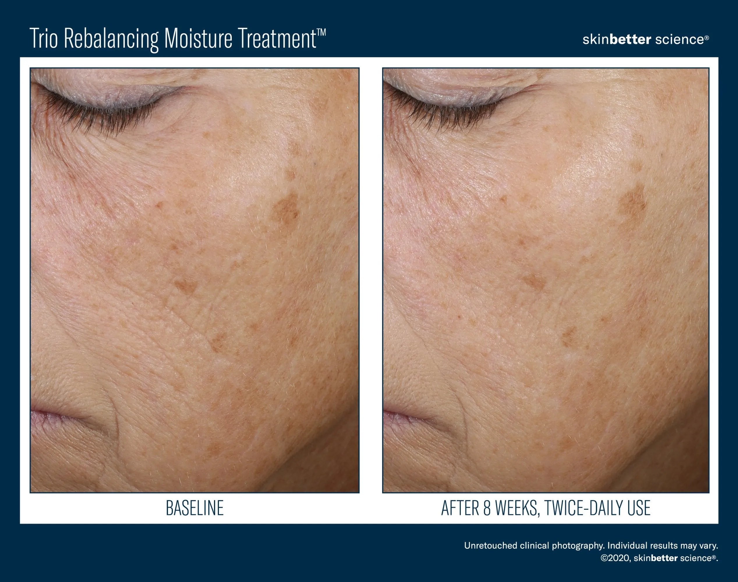 Before and after close-up of a woman's cheek showing improved skin tone with Trio Rebalancing Moisture Treatment.